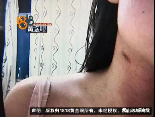 杭州一女子花三千点掉一颗黑痣 却长起一个红包